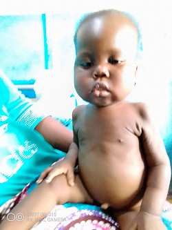 Enfant souffrant de malnutrition